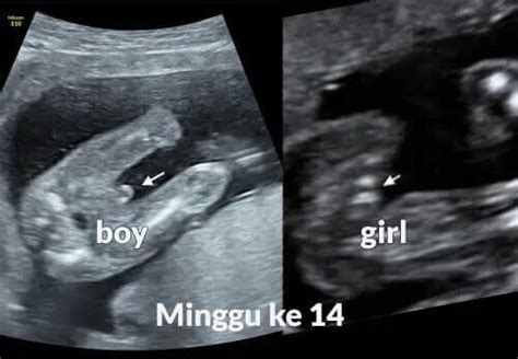 scan jantina bayi minggu 18